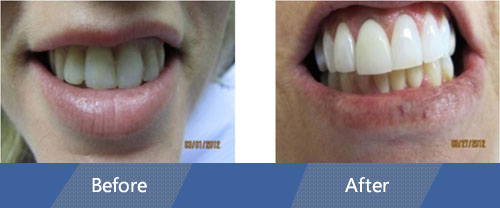 Cosmetic Veneers and Dental Crowns Before and after case 1