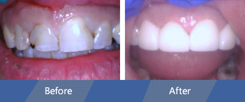 Dental Crowns Before and After