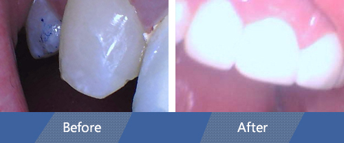 Dental Crowns Before and After 2