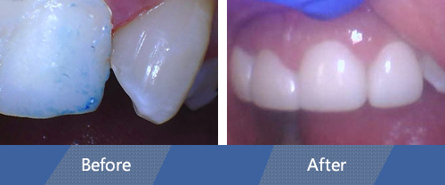 Dental Crowns Before and After 3