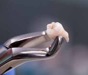 What methods of dental extractions are available with Franklin, OH area dentist?
